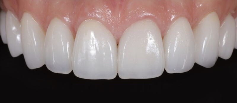After - Veneers Case 2 at Valley Dental & Orthodontics