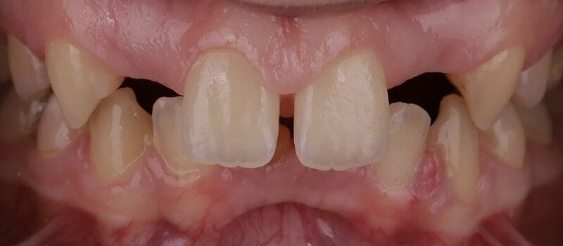 Before - Veneers Case 3 at Valley Dental & Orthodontics