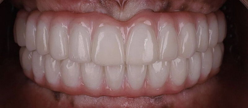 After - All-on-4 Case 1 at Valley Dental & Orthodontics