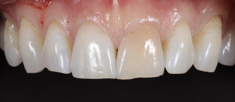 Before - Veneers Case 2 at Valley Dental & Orthodontics